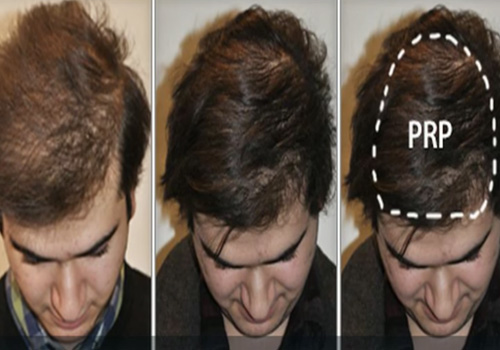 prp with hair regrowth in Vijayawada