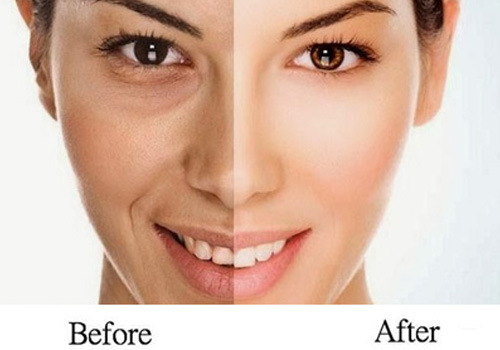 Skin Tightening treatment in vijayawada